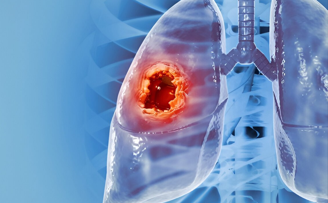 lung cancer